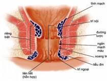 Kỹ thuật Longo điều trị bệnh: Mổ trĩ ít đau. Ưu và nhược điểm.