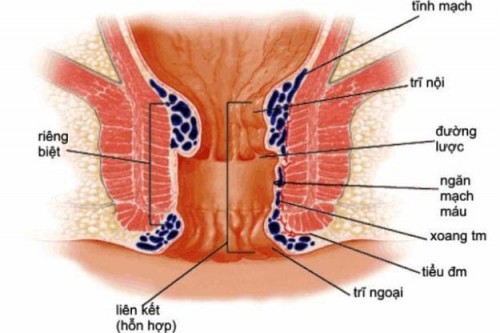 Kỹ thuật Longo điều trị bệnh: Mổ trĩ ít đau. Ưu và nhược điểm.