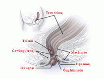 Chẩn đoán và điều trị bệnh trĩ