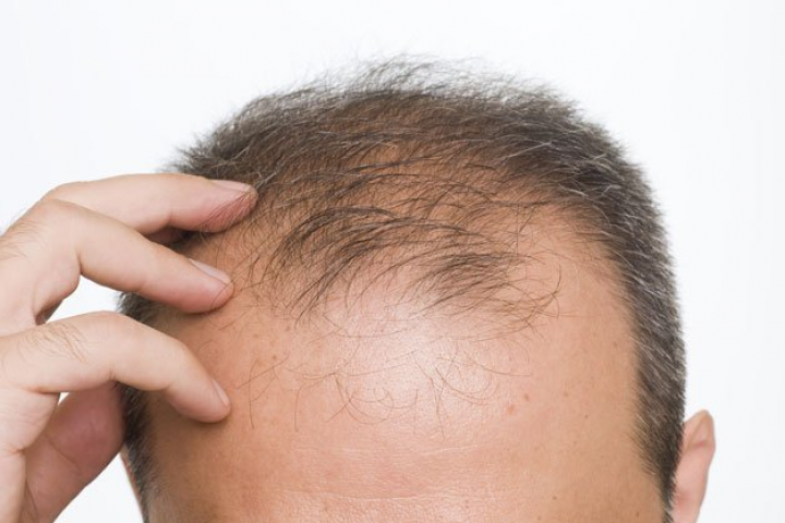 Bị rụng tóc nhiều ở nam là bệnh gì?
