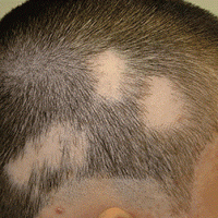 Kinh nghiệm chữa rụng tóc từng mảng hiệu quả nhất