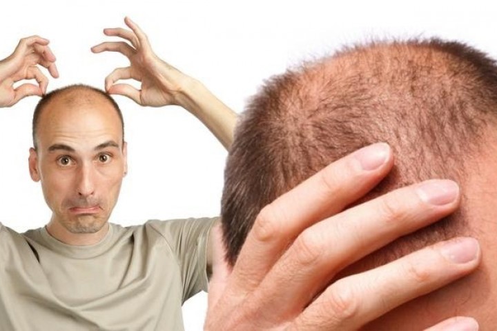 Vua Tóc Giả giúp xóa tan nỗi lo rụng tóc 2 bên thái dương
