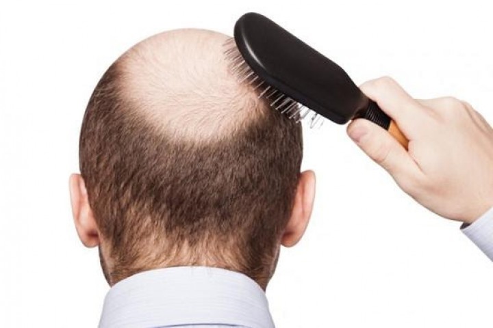 Rụng tóc bao nhiêu là nhiều? Nguyên nhân gây rụng tóc