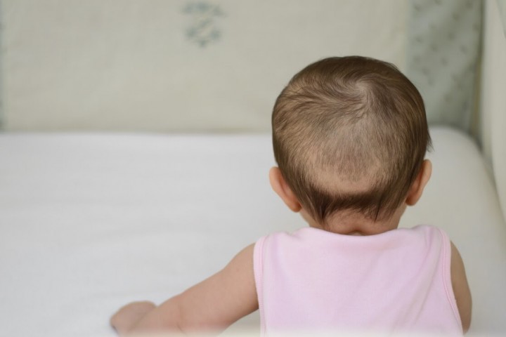 Rụng tóc hình vành khăn là như thế nào? Nguyên nhân và cách khắc phục