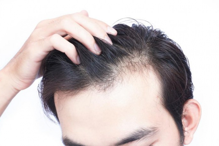 Rụng tóc hói đầu phải làm sao?