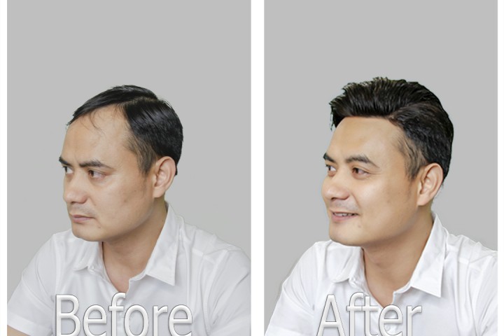 Cách đội mái hói chữ M đẹp tự nhiên